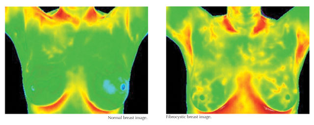 Thermography: What Your Doctor May Not Tell You